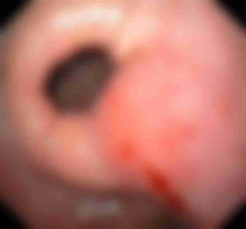 Diffuse Type Adenoca